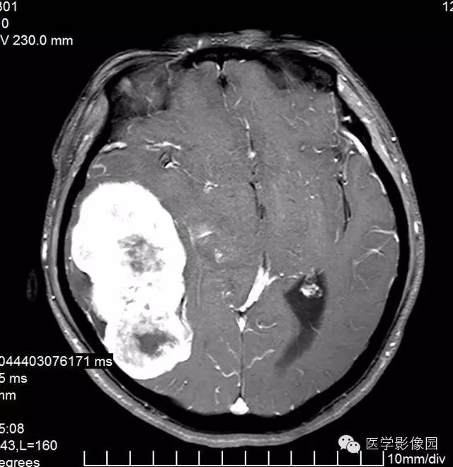 【病例】颅内血管外皮细胞瘤2例MR影像表现 【病例】颅内血管外皮细胞瘤2例MR影像表现