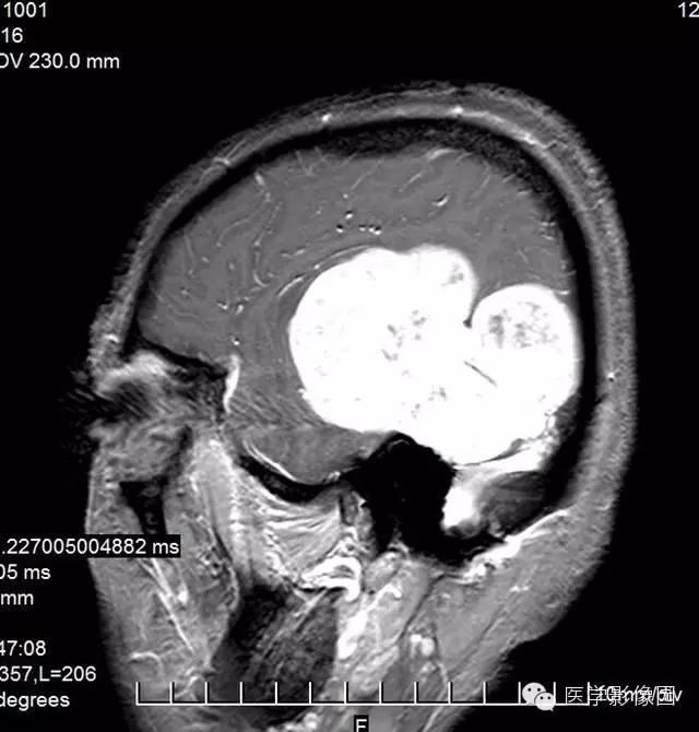 【病例】颅内血管外皮细胞瘤2例MR影像表现 【病例】颅内血管外皮细胞瘤2例MR影像表现