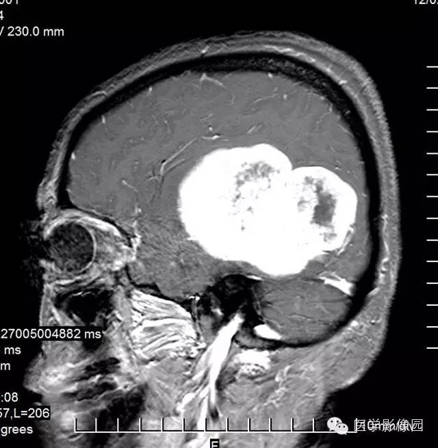 【病例】颅内血管外皮细胞瘤2例MR影像表现 【病例】颅内血管外皮细胞瘤2例MR影像表现