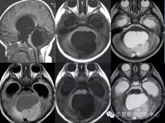 【病例】毛细胞型星形细胞瘤1例MR影像表现