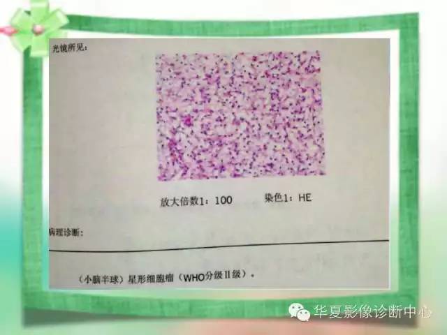 【病例】毛细胞型星形细胞瘤1例MR影像表现