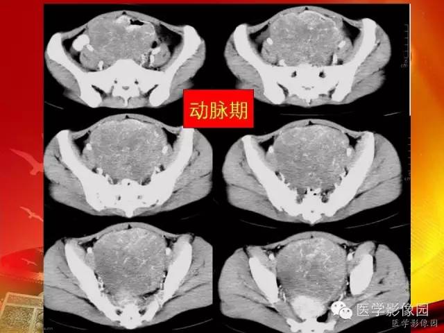 【病例】空肠间质瘤1例CT影像表现 【病例】空肠间质瘤1例CT影像表现