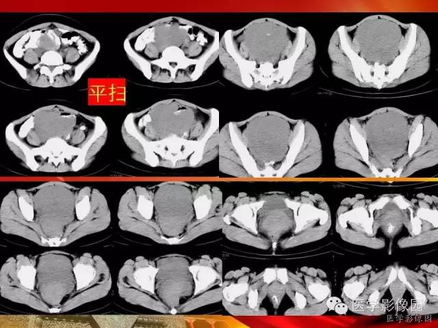 【病例】空肠间质瘤1例CT影像表现