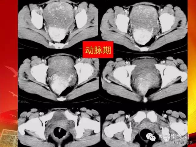 【病例】空肠间质瘤1例CT影像表现 【病例】空肠间质瘤1例CT影像表现