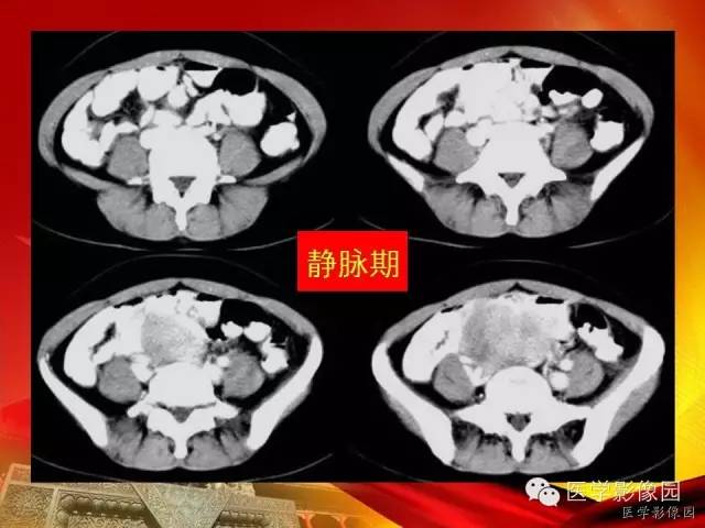 【病例】空肠间质瘤1例CT影像表现 【病例】空肠间质瘤1例CT影像表现