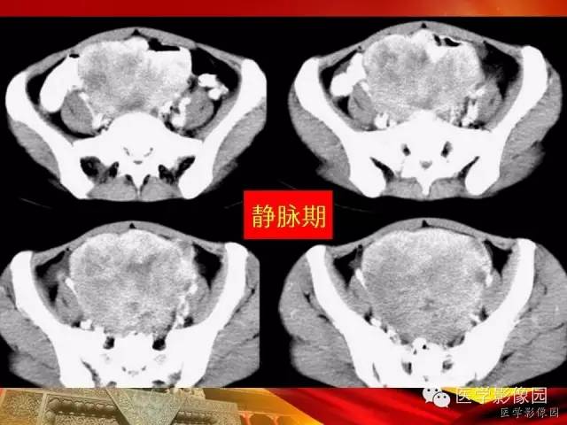 【病例】空肠间质瘤1例CT影像表现 【病例】空肠间质瘤1例CT影像表现
