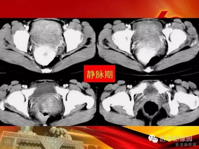 【病例】空肠间质瘤1例CT影像表现 【病例】空肠间质瘤1例CT影像表现