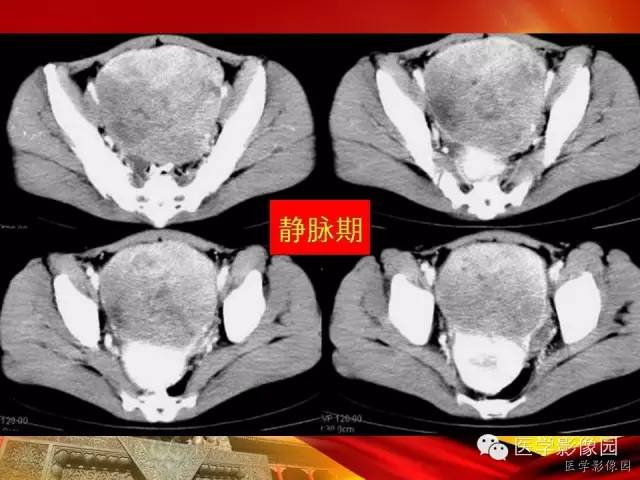 【病例】空肠间质瘤1例CT影像表现 【病例】空肠间质瘤1例CT影像表现