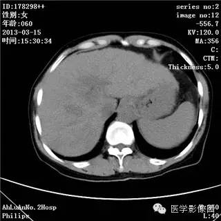【病例】肝癌伴门静脉癌栓形成1例CT影像表现 【病例】肝癌伴门静脉癌栓形成1例CT影像表现