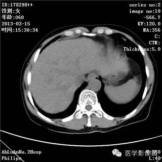 【病例】肝癌伴门静脉癌栓形成1例CT影像表现
