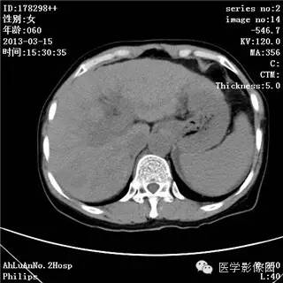【病例】肝癌伴门静脉癌栓形成1例CT影像表现 【病例】肝癌伴门静脉癌栓形成1例CT影像表现