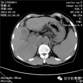 【病例】肝癌伴门静脉癌栓形成1例CT影像表现 【病例】肝癌伴门静脉癌栓形成1例CT影像表现