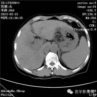 【病例】肝癌伴门静脉癌栓形成1例CT影像表现 【病例】肝癌伴门静脉癌栓形成1例CT影像表现