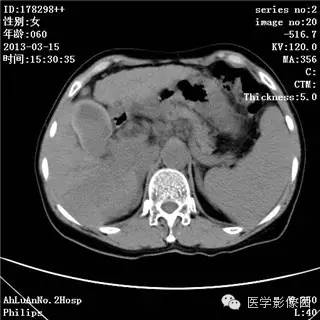 【病例】肝癌伴门静脉癌栓形成1例CT影像表现 【病例】肝癌伴门静脉癌栓形成1例CT影像表现