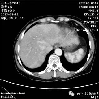 【病例】肝癌伴门静脉癌栓形成1例CT影像表现 【病例】肝癌伴门静脉癌栓形成1例CT影像表现