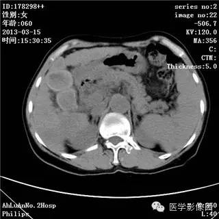 【病例】肝癌伴门静脉癌栓形成1例CT影像表现 【病例】肝癌伴门静脉癌栓形成1例CT影像表现
