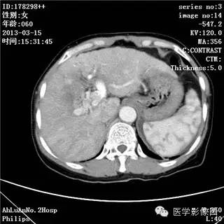 【病例】肝癌伴门静脉癌栓形成1例CT影像表现 【病例】肝癌伴门静脉癌栓形成1例CT影像表现