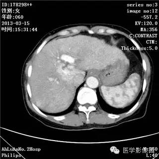 【病例】肝癌伴门静脉癌栓形成1例CT影像表现 【病例】肝癌伴门静脉癌栓形成1例CT影像表现