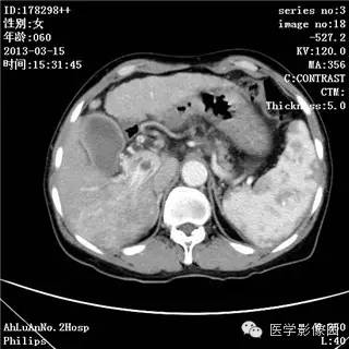 【病例】肝癌伴门静脉癌栓形成1例CT影像表现 【病例】肝癌伴门静脉癌栓形成1例CT影像表现