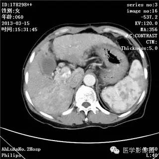 【病例】肝癌伴门静脉癌栓形成1例CT影像表现 【病例】肝癌伴门静脉癌栓形成1例CT影像表现