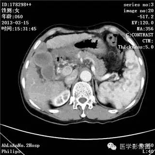 【病例】肝癌伴门静脉癌栓形成1例CT影像表现 【病例】肝癌伴门静脉癌栓形成1例CT影像表现