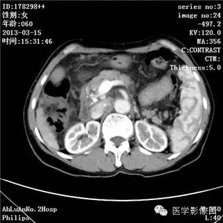 【病例】肝癌伴门静脉癌栓形成1例CT影像表现 【病例】肝癌伴门静脉癌栓形成1例CT影像表现
