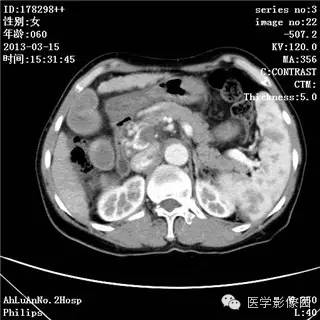 【病例】肝癌伴门静脉癌栓形成1例CT影像表现 【病例】肝癌伴门静脉癌栓形成1例CT影像表现