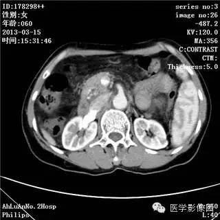 【病例】肝癌伴门静脉癌栓形成1例CT影像表现 【病例】肝癌伴门静脉癌栓形成1例CT影像表现