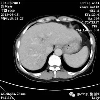 【病例】肝癌伴门静脉癌栓形成1例CT影像表现 【病例】肝癌伴门静脉癌栓形成1例CT影像表现
