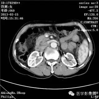 【病例】肝癌伴门静脉癌栓形成1例CT影像表现 【病例】肝癌伴门静脉癌栓形成1例CT影像表现