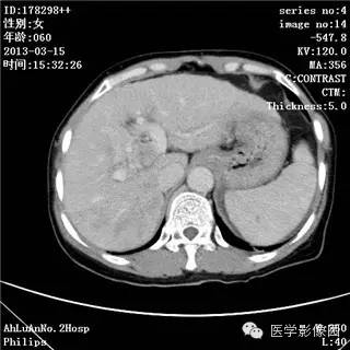 【病例】肝癌伴门静脉癌栓形成1例CT影像表现 【病例】肝癌伴门静脉癌栓形成1例CT影像表现