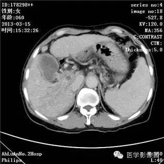 【病例】肝癌伴门静脉癌栓形成1例CT影像表现 【病例】肝癌伴门静脉癌栓形成1例CT影像表现