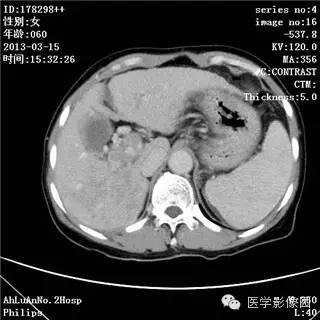 【病例】肝癌伴门静脉癌栓形成1例CT影像表现 【病例】肝癌伴门静脉癌栓形成1例CT影像表现