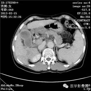 【病例】肝癌伴门静脉癌栓形成1例CT影像表现 【病例】肝癌伴门静脉癌栓形成1例CT影像表现
