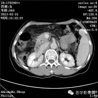 【病例】肝癌伴门静脉癌栓形成1例CT影像表现 【病例】肝癌伴门静脉癌栓形成1例CT影像表现