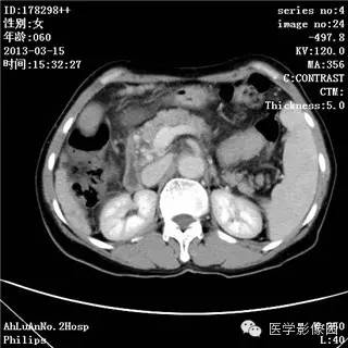 【病例】肝癌伴门静脉癌栓形成1例CT影像表现 【病例】肝癌伴门静脉癌栓形成1例CT影像表现