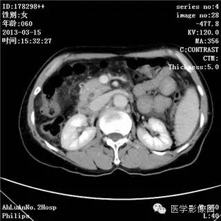 【病例】肝癌伴门静脉癌栓形成1例CT影像表现 【病例】肝癌伴门静脉癌栓形成1例CT影像表现