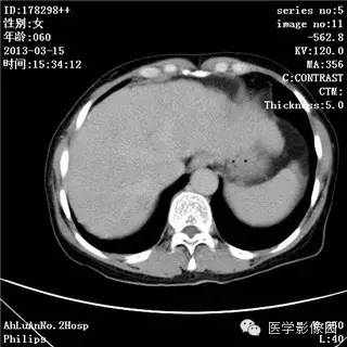 【病例】肝癌伴门静脉癌栓形成1例CT影像表现 【病例】肝癌伴门静脉癌栓形成1例CT影像表现