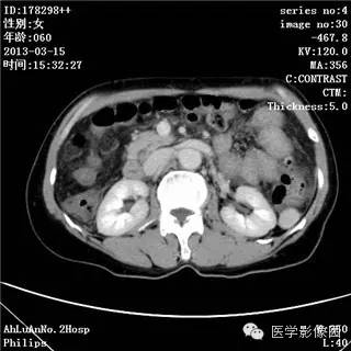 【病例】肝癌伴门静脉癌栓形成1例CT影像表现 【病例】肝癌伴门静脉癌栓形成1例CT影像表现