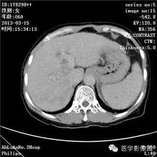 【病例】肝癌伴门静脉癌栓形成1例CT影像表现 【病例】肝癌伴门静脉癌栓形成1例CT影像表现