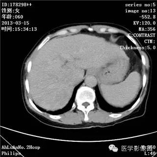【病例】肝癌伴门静脉癌栓形成1例CT影像表现 【病例】肝癌伴门静脉癌栓形成1例CT影像表现