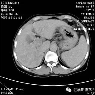 【病例】肝癌伴门静脉癌栓形成1例CT影像表现 【病例】肝癌伴门静脉癌栓形成1例CT影像表现