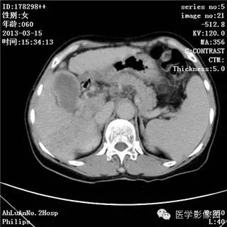 【病例】肝癌伴门静脉癌栓形成1例CT影像表现 【病例】肝癌伴门静脉癌栓形成1例CT影像表现