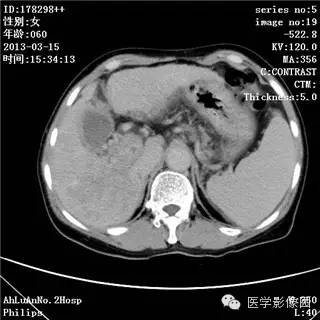 【病例】肝癌伴门静脉癌栓形成1例CT影像表现 【病例】肝癌伴门静脉癌栓形成1例CT影像表现