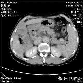 【病例】肝癌伴门静脉癌栓形成1例CT影像表现 【病例】肝癌伴门静脉癌栓形成1例CT影像表现