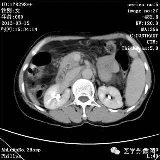 【病例】肝癌伴门静脉癌栓形成1例CT影像表现 【病例】肝癌伴门静脉癌栓形成1例CT影像表现