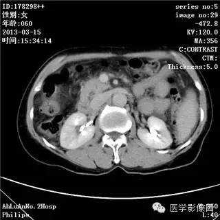 【病例】肝癌伴门静脉癌栓形成1例CT影像表现 【病例】肝癌伴门静脉癌栓形成1例CT影像表现