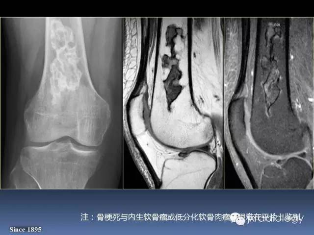【PPT】硬化性骨肿瘤或肿瘤样病变