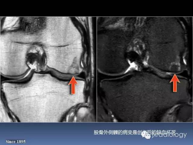 【PPT】硬化性骨肿瘤或肿瘤样病变