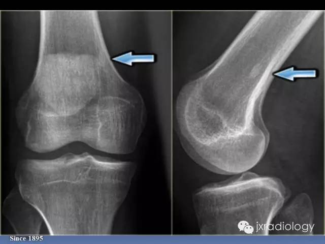 【PPT】硬化性骨肿瘤或肿瘤样病变